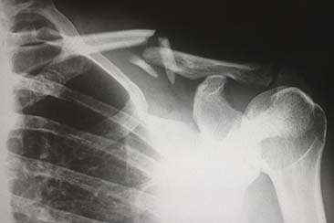 Productive Activities Following a Serious Injury Productive Activities Following a Serious Injury